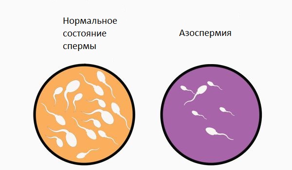 Семенная жидкость в норме и азооспермия